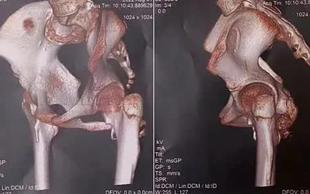 Phát hiện hội chứng "người hóa đá" thể hiếm ở một bé gái 12 tuổi