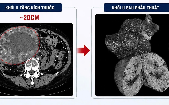 Khối u gan “lớn nhanh như thổi”, tăng kích thước 10 lần sau khi uống loại nước này thường xuyên