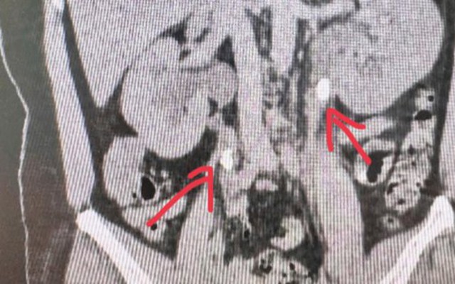 Bác sĩ giật mình khi xem hình ảnh CT thận của bệnh nhân