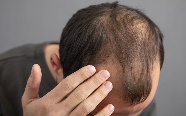 Thường xuyên ăn 5 món này, đừng trách vì sao tóc rụng lả tả