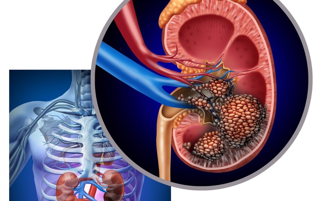 Người đàn ông bất ngờ phát hiện ung thư thận khi đi khám sức khỏe định kỳ: Tôi mới 32 tuổi, sao có thể...
