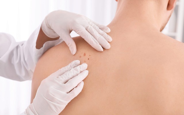 Đây là dấu hiệu sớm nhất của ung thư da nhưng rất hay bị bỏ qua