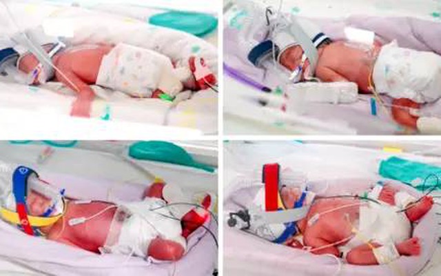 Người phụ nữ sinh 4 bé gái giống hệt nhau cùng trứng, cùng chung một bánh nhau; bác sĩ nói: "Gần như chưa từng có"