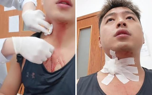 Người đàn ông suýt "gặp họa" vì một cú đập muỗi làm vỡ mạch máu ở cổ