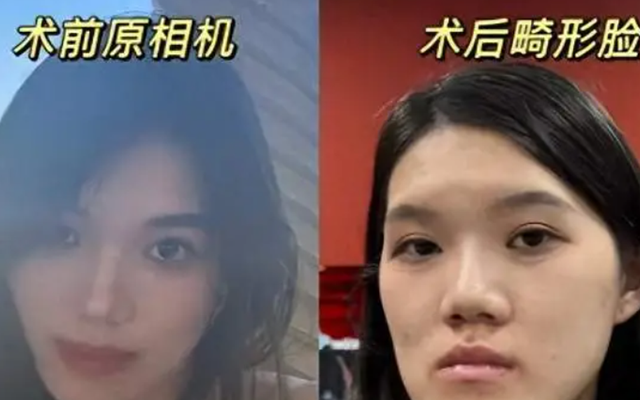 Nữ người mẫu 24 tuổi phẫu thuật thẩm mỹ từ bị móm nhẹ thành mặt lưỡi cày: Lời giải thích của bác sĩ gây phẫn nộ