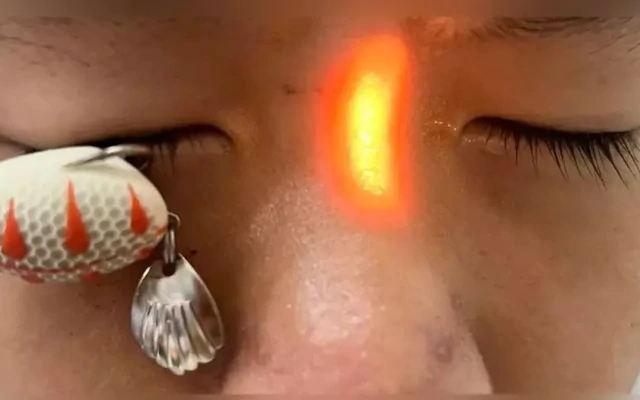 Lưỡi câu ghim thẳng vào mắt bé trai 13 tuổi gây mù