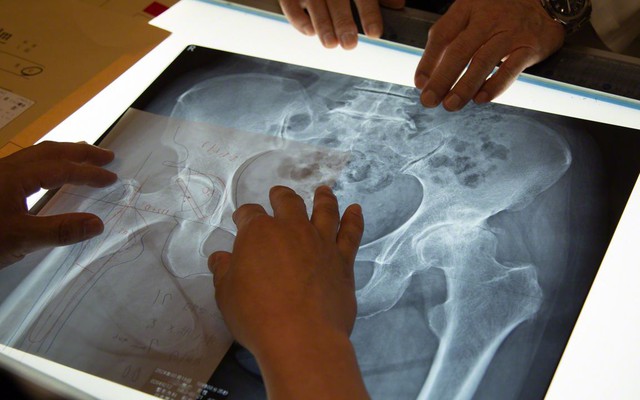 Cụ bà 70 tuổi có xương trẻ khỏe như phụ nữ 30, bác sĩ kinh ngạc khi biết bí quyết
