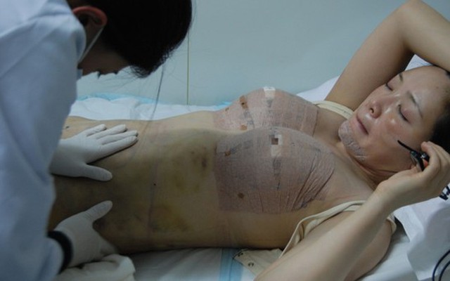 Diễn viên Đài Loan công khai quá trình mổ nâng ngực