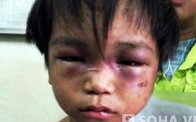 Vụ bé 3 tuổi bị bạo hành: Chưa cách ly bé khỏi người cậu dã tâm