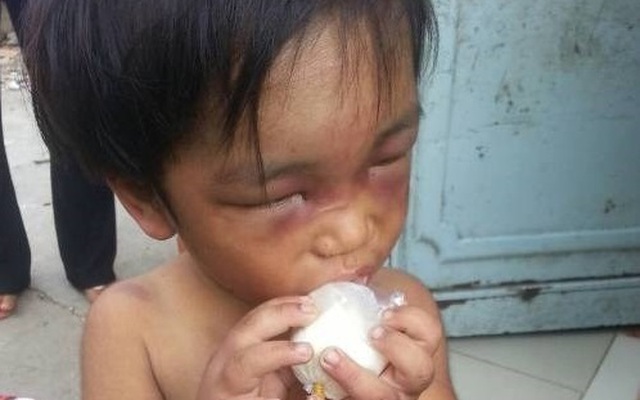 TP.HCM: Bé 3 tuổi bị châm tàn thuốc, đánh bầm mắt bắt đi ăn xin