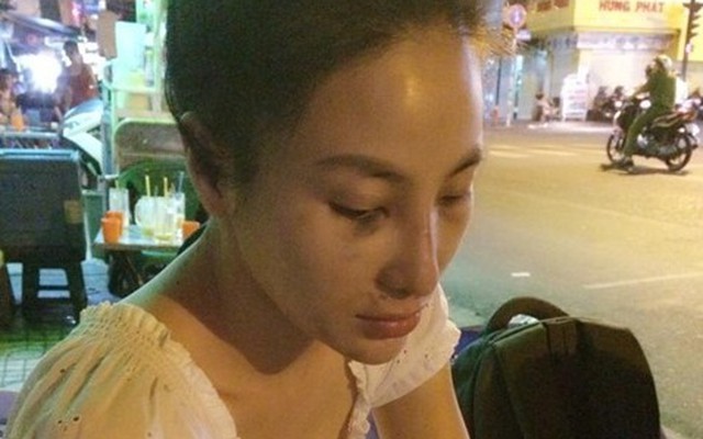 Hoa hậu người Việt Thế giới bị bạn trai đánh bầm dập