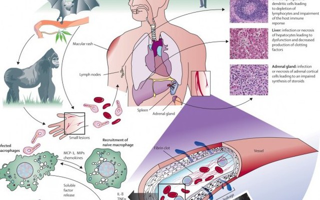 Các triệu chứng bệnh Ebola và cách điều trị khi mắc bệnh