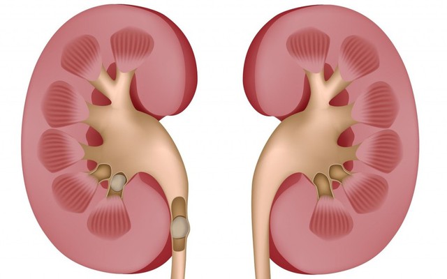 Chỉ cần 6 quả chanh, bạn đã ngăn ngừa được bệnh sỏi thận