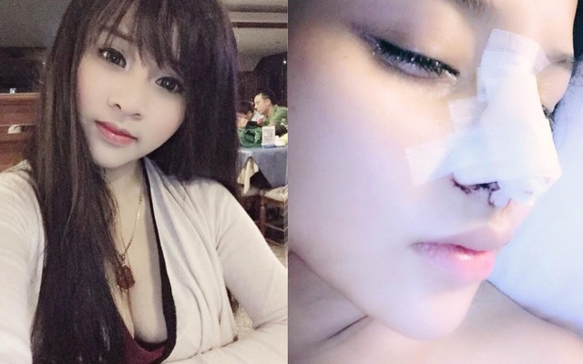 Trang Venus chi 126 triệu để làm lại mũi vì có dấu hiệu tụt sụn