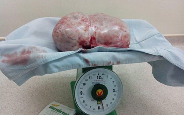 Bóc tách thành công khối u buồng trứng nặng gần 6kg