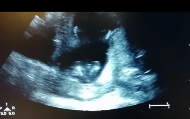 Thai nhi 4 tháng tuổi vỗ tay trong bụng mẹ