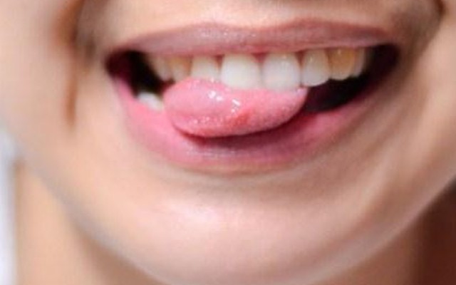 Đoán bệnh qua những biểu hiện ở lưỡi