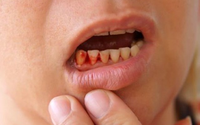 Sai lầm khi xỉa răng khiến bạn "rước họa" khôn lường