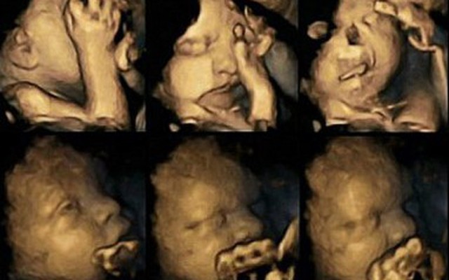 "Sốc" với hình ảnh "nhăn nhó" của thai nhi khi mẹ bầu hút thuốc lá