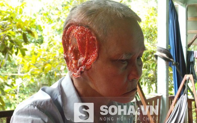 Căn bệnh khủng khiếp "ăn" mất tai người đàn ông ở Tiền Giang