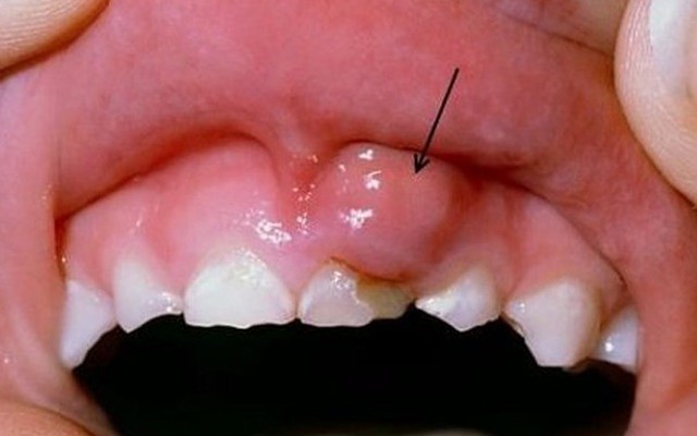 Cảnh báo: Bạn có thể chết vì 1 căn bệnh tưởng bình thường ở răng
