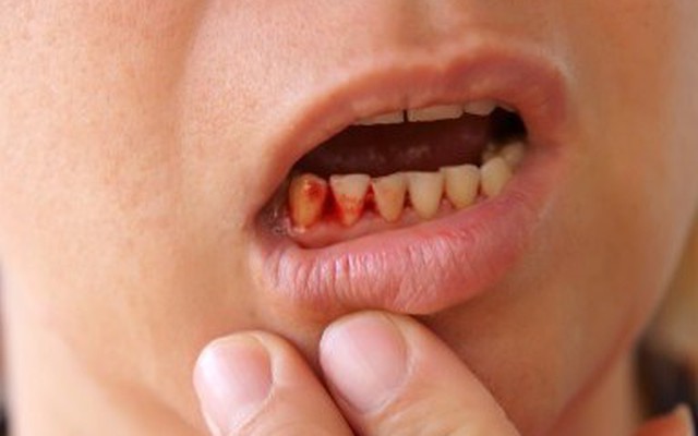 Chảy máu chân răng: Dấu hiệu bệnh ung thư nguy hiểm bạn phải biết