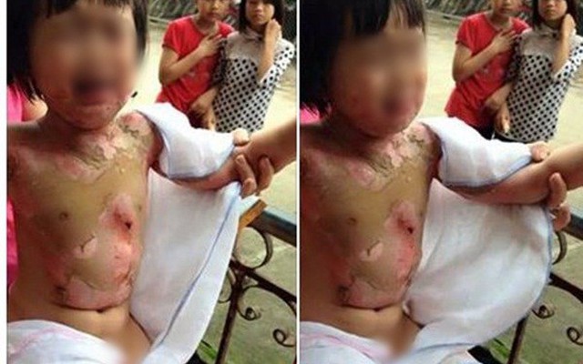Cô giáo bàng hoàng kể giây phút bé 3 tuổi bị bạn đốt ở Yên Bái