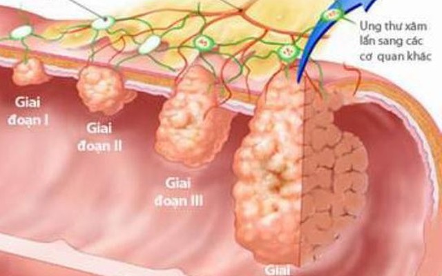 Những dấu hiệu cảnh báo bạn đã mắc ung thư giai đoạn đầu