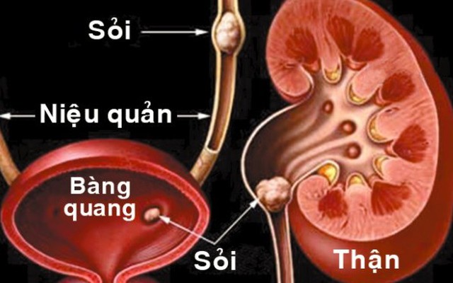 Bài thuốc quý "đánh bật" sỏi thận chỉ trong vài ngày không cần mổ