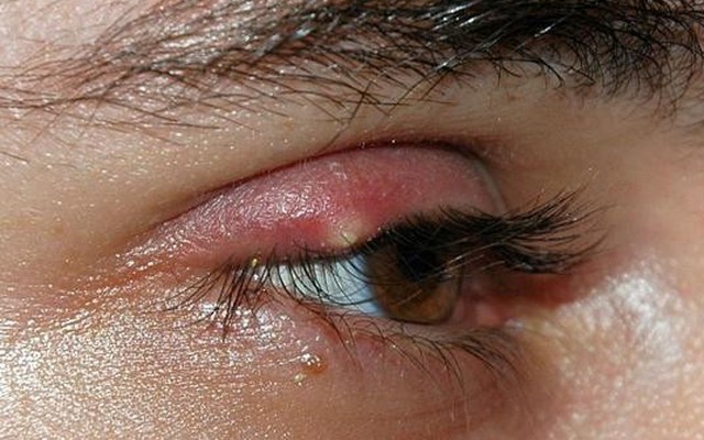 Mẹo chữa lẹo mắt “thần tốc” tại nhà không để lại sẹo xấu