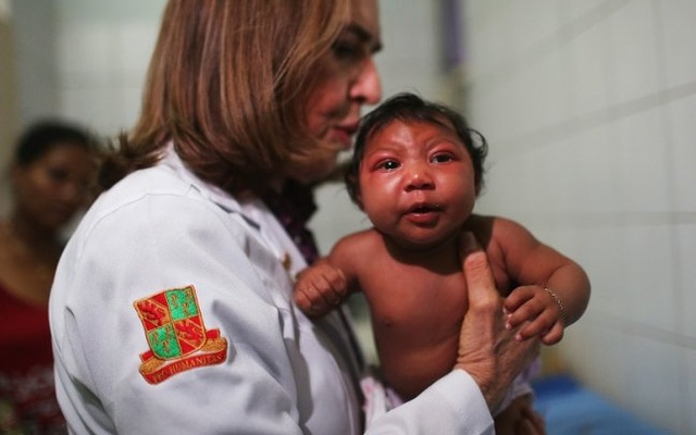 Ngoài Zika, virus CMV cũng gây teo não ở trẻ sơ sinh
