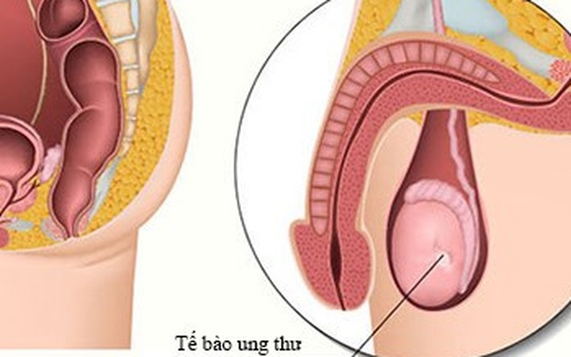 Dấu hiệu ung thư tinh hoàn