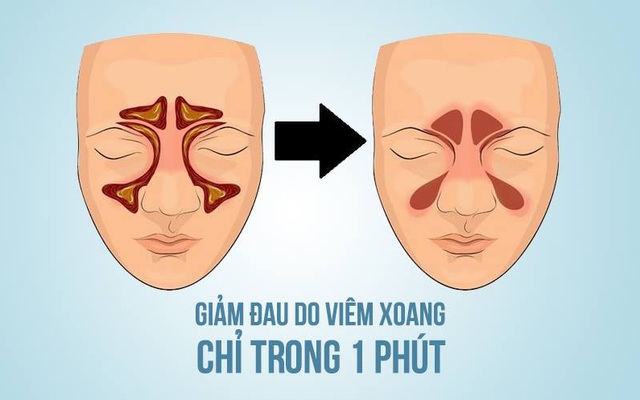 Bác sĩ Mỹ hướng dẫn cách giảm đau do viêm xoang chỉ trong 1 phút