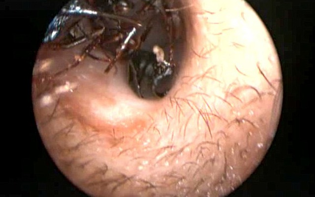 1.000 con kiến trong tai cô bé 12 tuổi khiến bác sĩ phải "bó tay"
