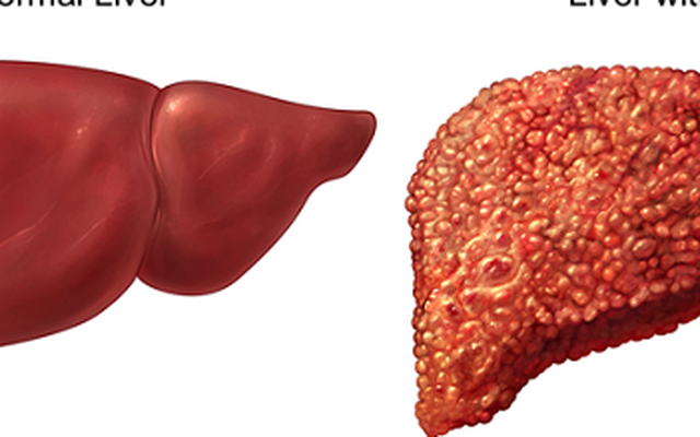 4 "nên và không nên" để tránh xa ung thư gan