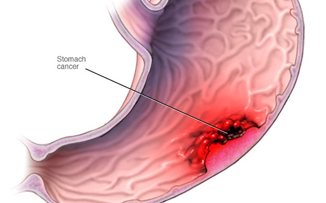 6 cách phòng tránh ung thư dạ dày ai cũng nên thực hiện