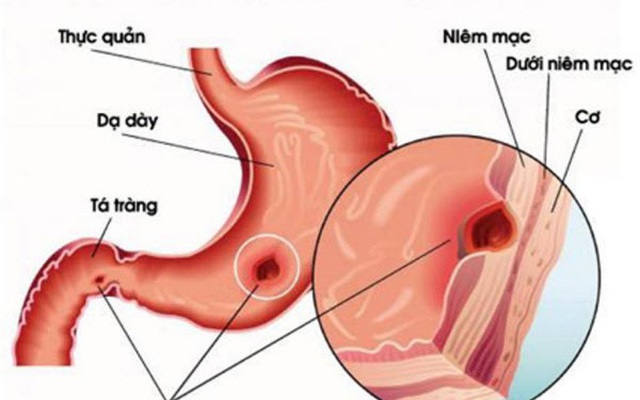 7 bí quyết bảo vệ dạ dày hiệu quả nhất ai cũng nên biết