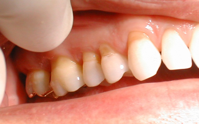Bí quyết chăm sóc răng nhạy cảm