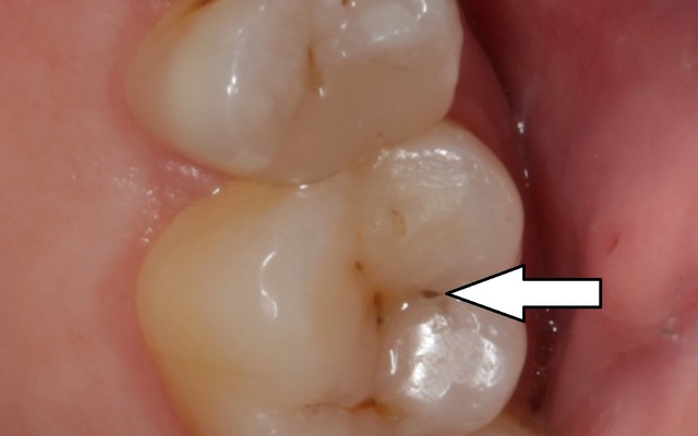 7 thói quen hàng ngày bạn phải tránh để không bị sâu răng