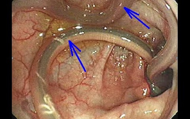 Bác sĩ sốc vì 40 con vật kinh khủng trong ống mật người bệnh