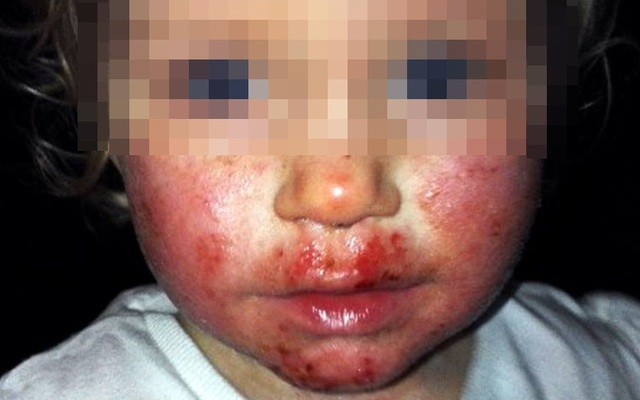 Khuôn mặt bé gái 2 tuổi như bị "tạt axit": Đau lòng khi lỗi do thói quen của người lớn