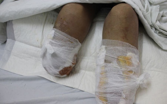 Hãi hùng nhân viên y tế tự cắt lìa chân mình