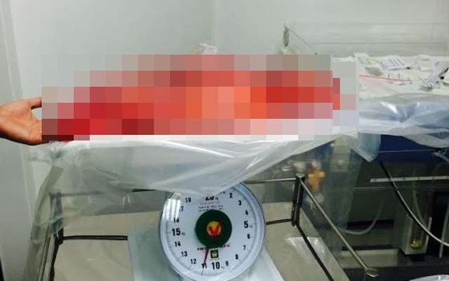 Khối u khổng lồ trong bụng bà cụ 100 tuổi ở Đồng Nai