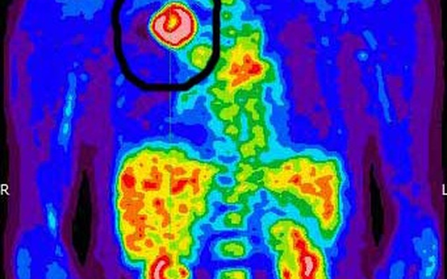 Có thể dùng PET Scan để phát hiện sớm ung thư không?