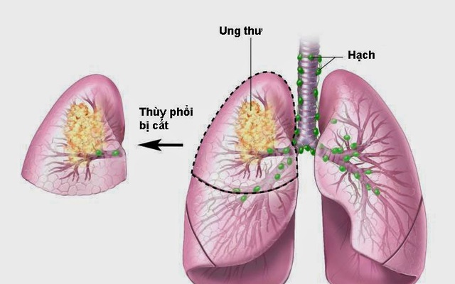 Khói thuốc là nguyên nhân chính gây ung thư phổi ở phụ nữ