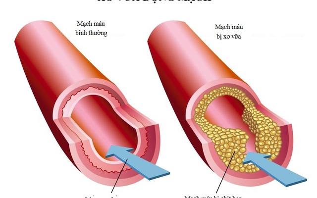 Bệnh tim mạch: Căn bệnh giết người nhiều hơn cả bệnh ung thư