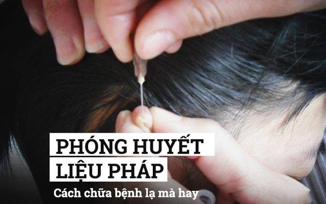 Phóng huyết liệu pháp: Cách chữa bệnh "kỳ diệu" của người xưa