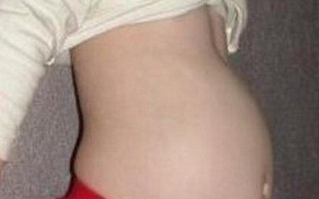 Kỳ lạ bé gái 4 tuổi có thai nhi trong bụng