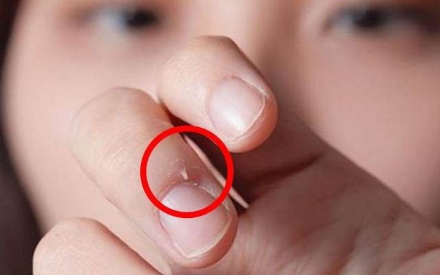 Bé 7 tuổi suýt bị cắt bỏ ngón tay vì thói quen "cắn": Bố mẹ nên "cai nghiện" cho con