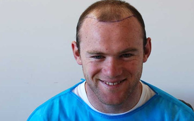 Chi cả tỷ đồng cứu chữa, tóc của Rooney vẫn lơ thơ như ông già